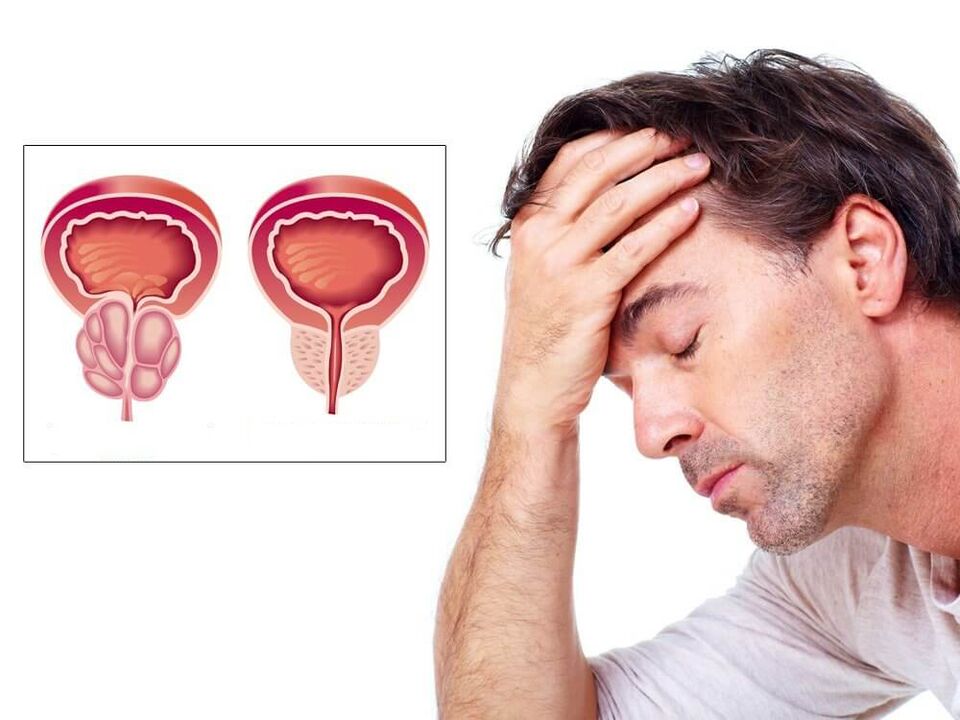 Síntomas da inflamación da próstata nos homes
