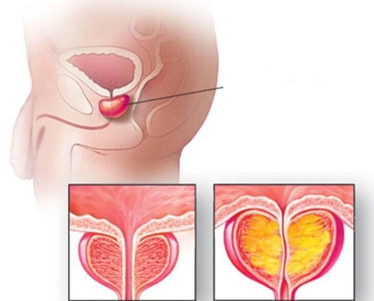 Localización da próstata, próstata normal e agrandada na prostatite crónica