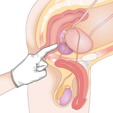 Determinación do estado da próstata por palpación para diagnosticar prostatite