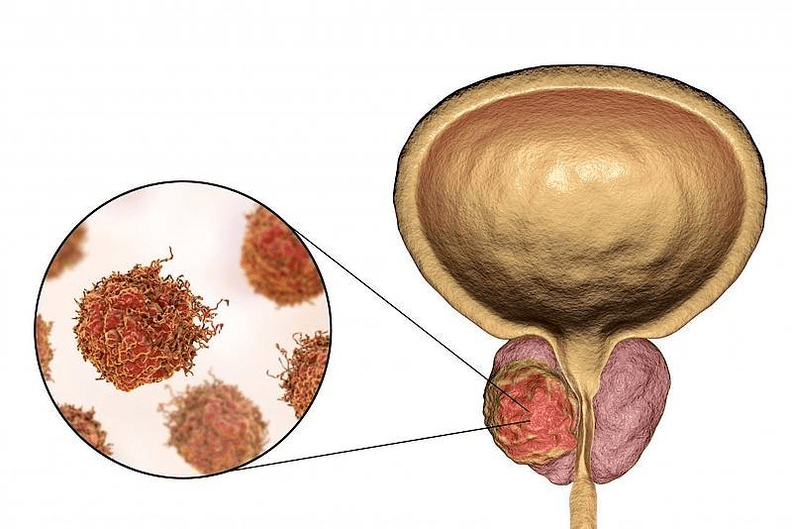 Como é o dano da próstata