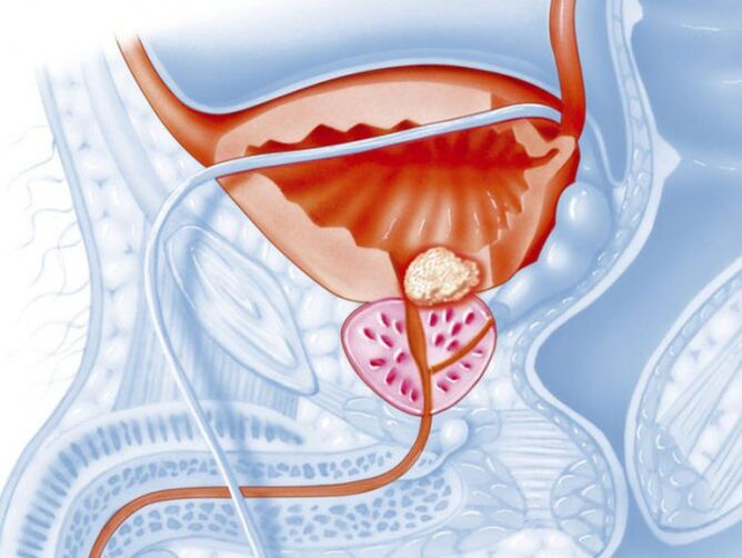 Prostatite bacteriana