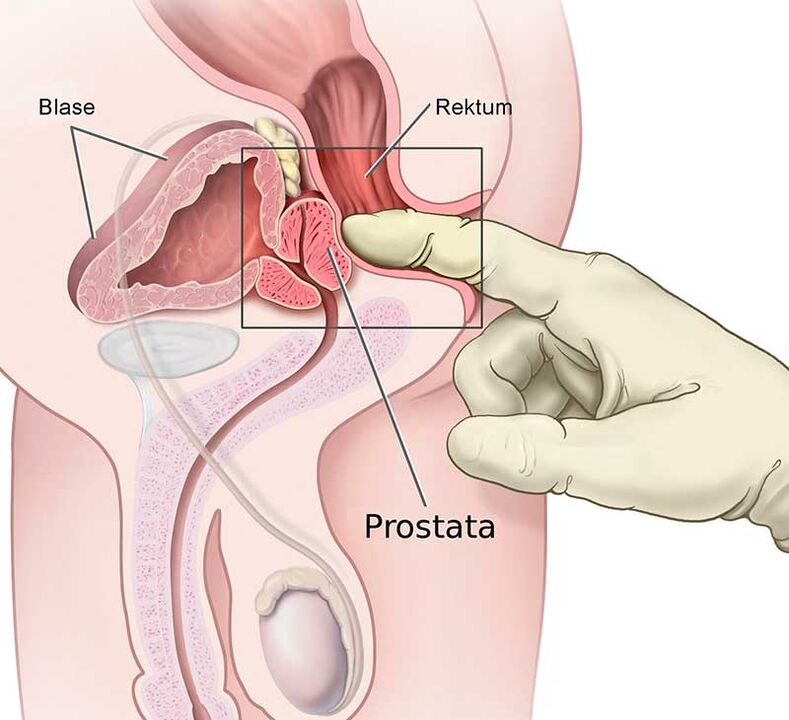 Masaxe prostática para prostatite